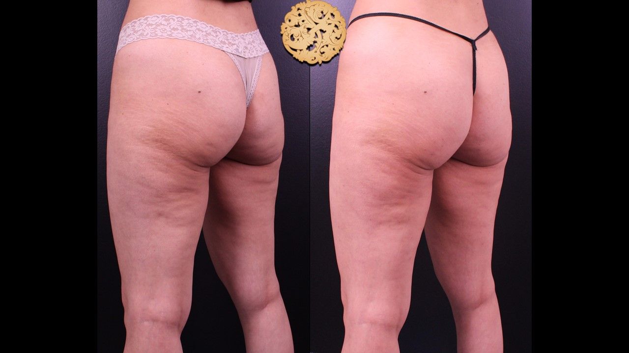 Cellfina Before & After