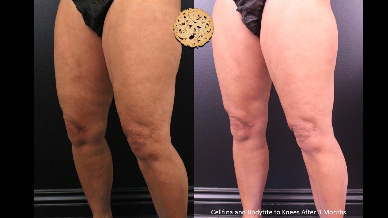 Cellfina Before & After