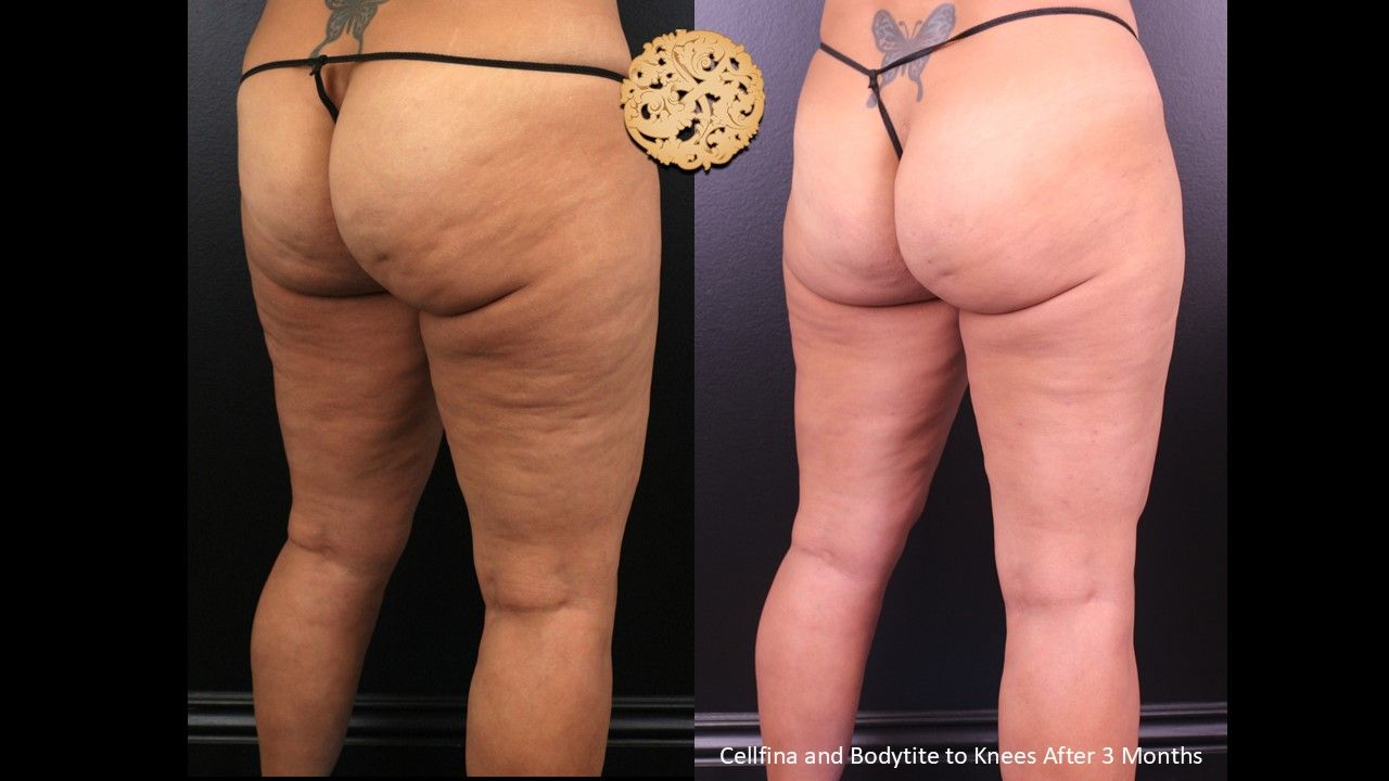 Cellfina Before & After