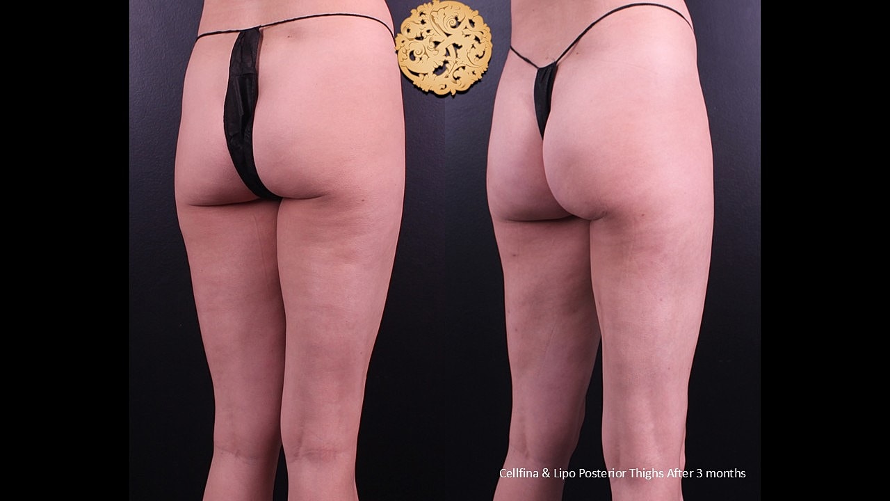 Cellfina & Lipo Posterior tights after 3 months