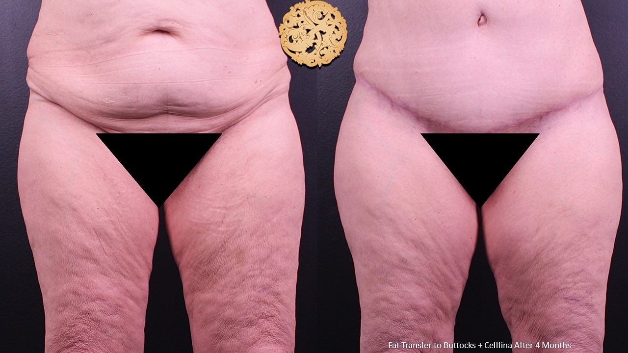 Cellulite Treatment Before & After