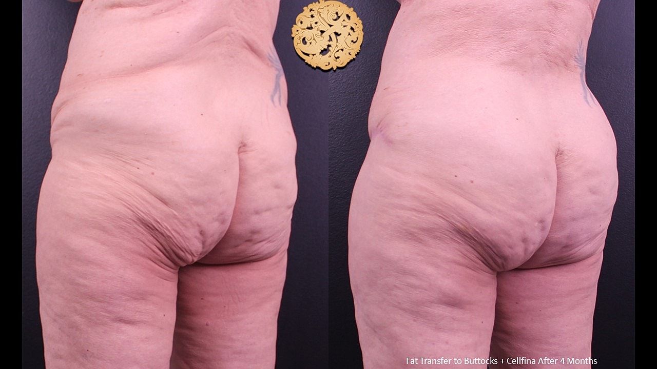 Cellulite Treatment Before & After
