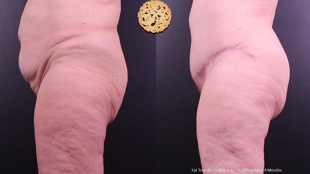 Cellulite Treatment Before & After