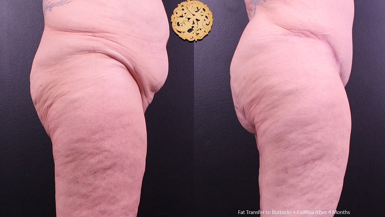 Cellulite Treatment Before & After