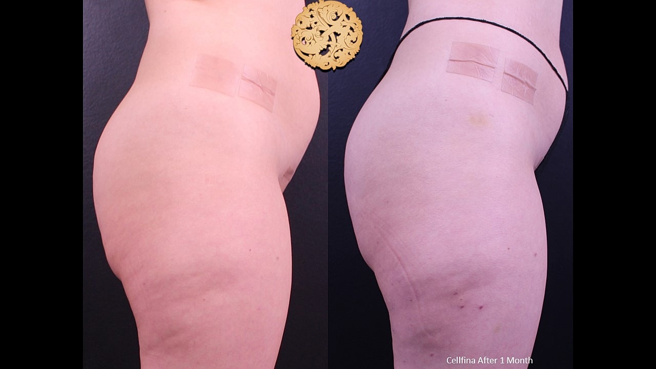 Cellulite Treatment Before & After