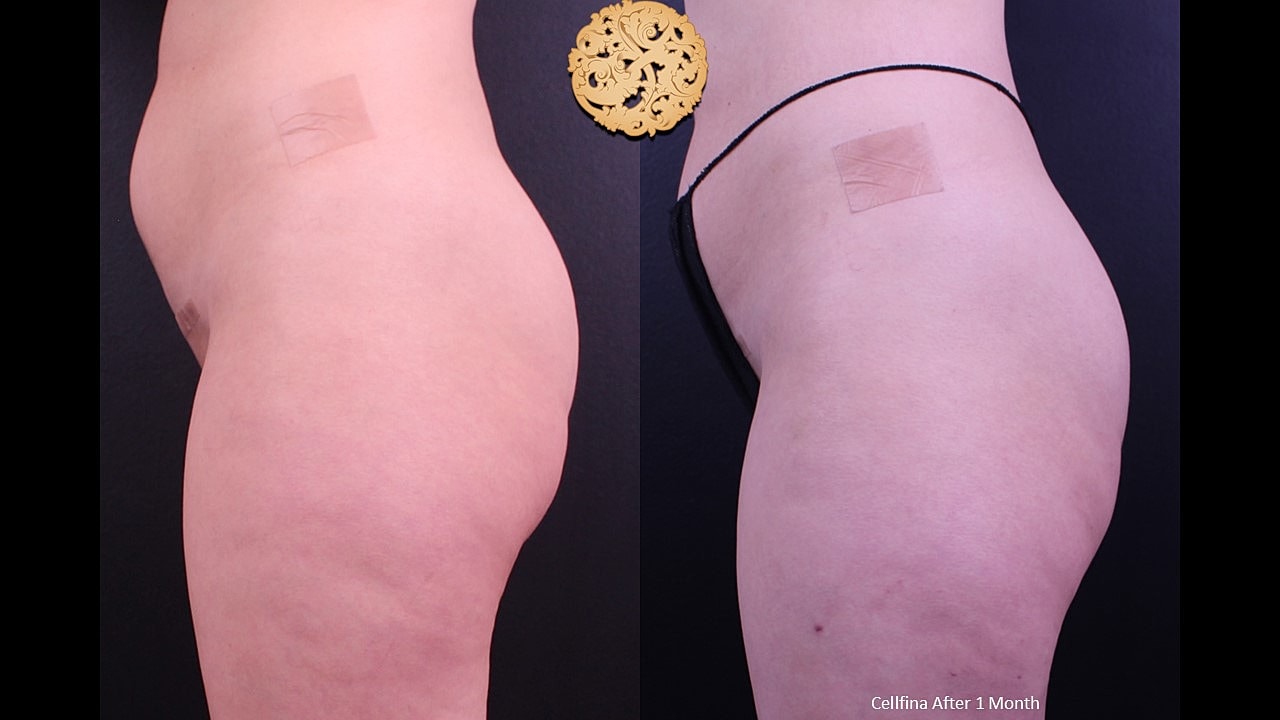 Cellulite Treatment Before & After