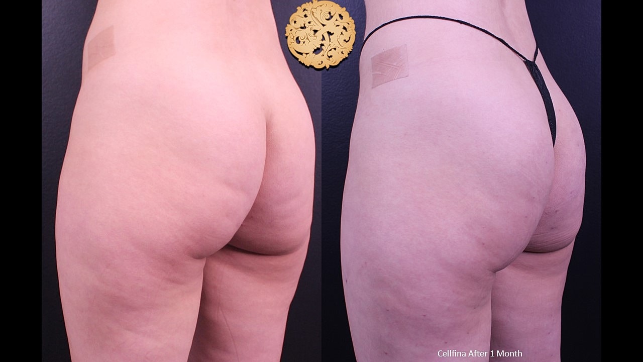Cellulite Treatment Before & After