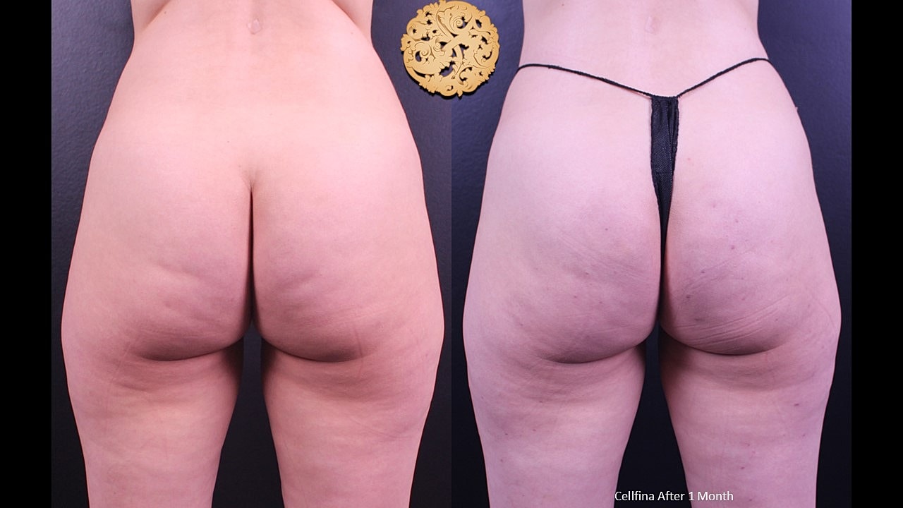 Cellulite Treatment Before & After