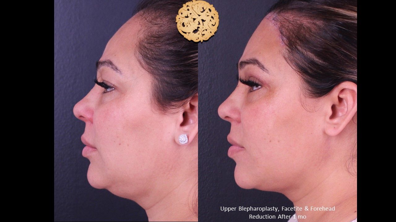 Forehead Reduction Before & After