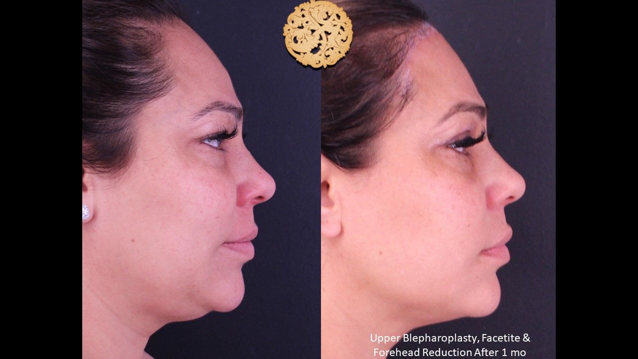 Forehead Reduction Before & After