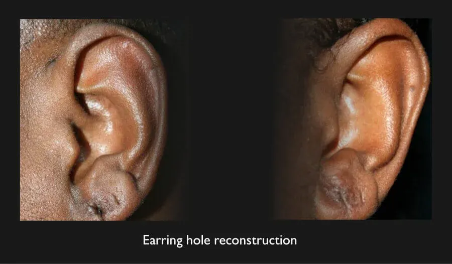 Earring Hole Reconstruction Before & After