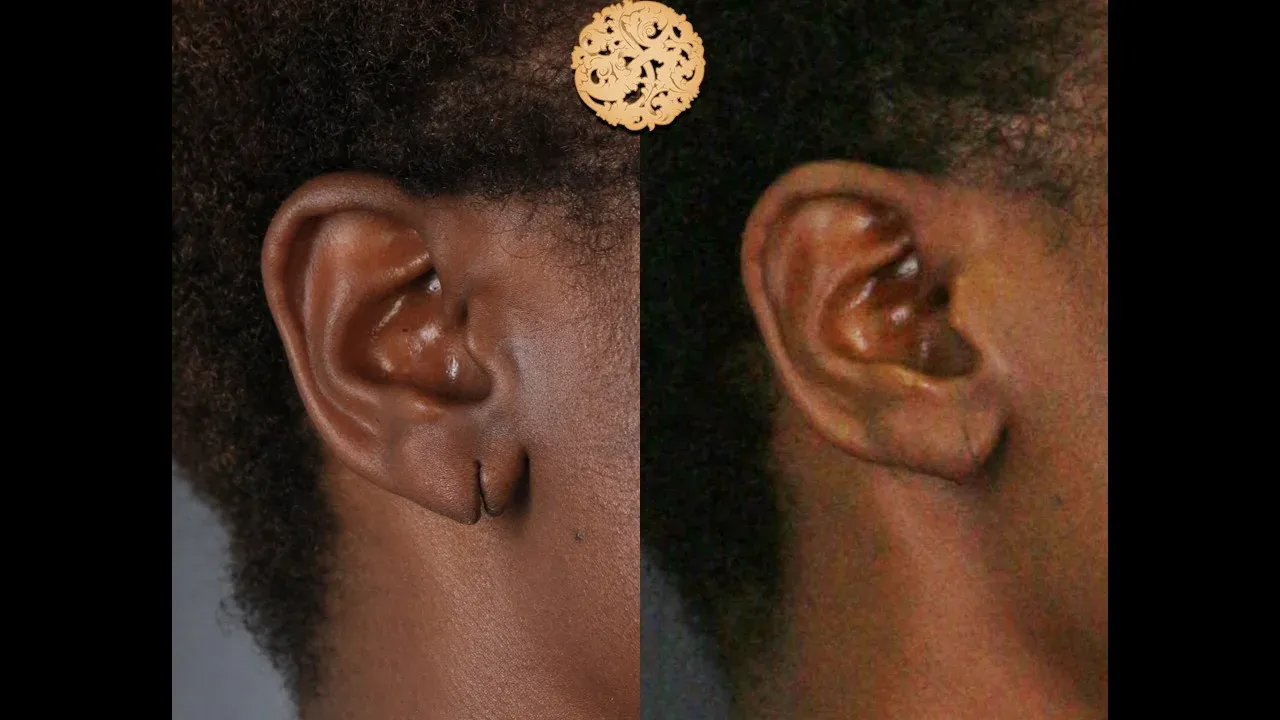 Earring Hole Reconstruction Before & After