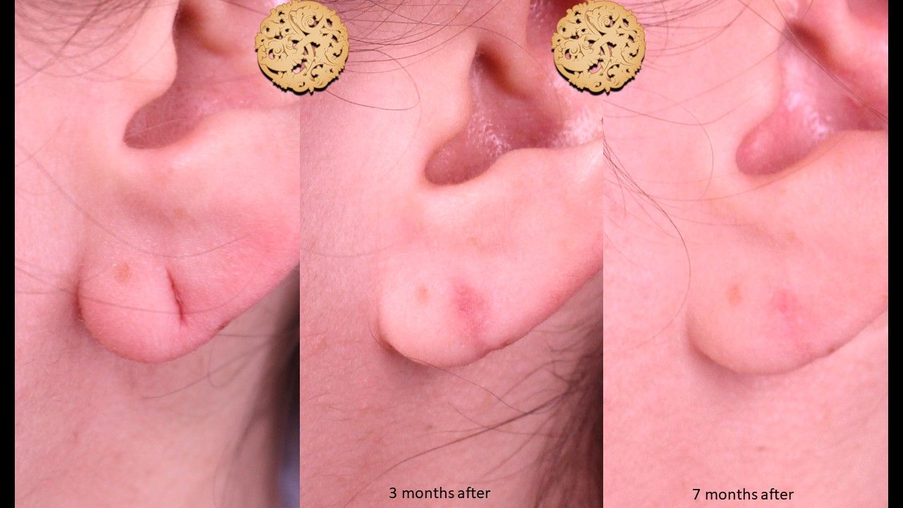 Earring Hole Reconstruction Before & After