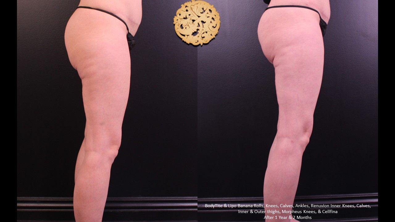 Renuvion Before & After