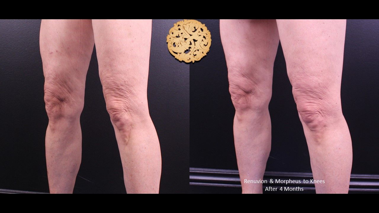 Renuvion Before & After