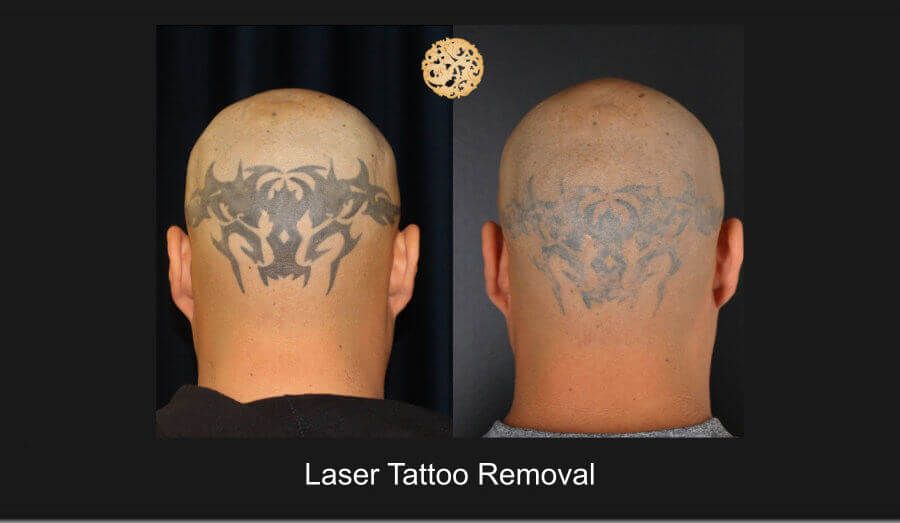 PicoSure Before & After