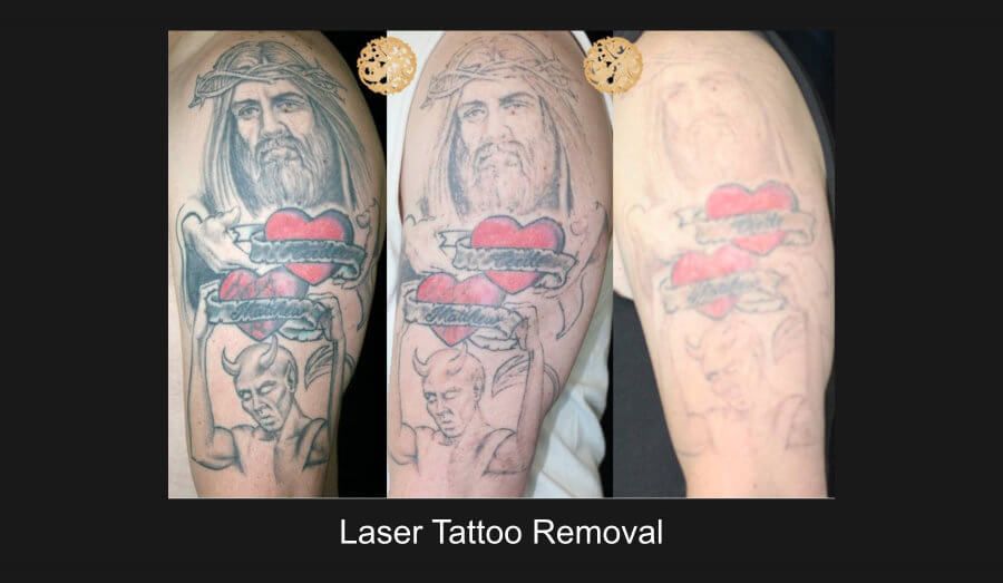 PicoSure Before & After