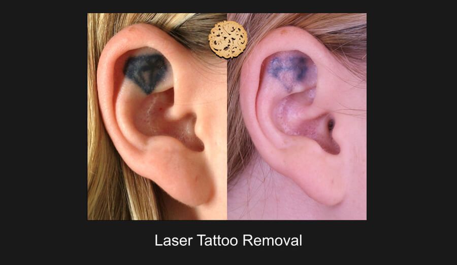 PicoSure Before & After