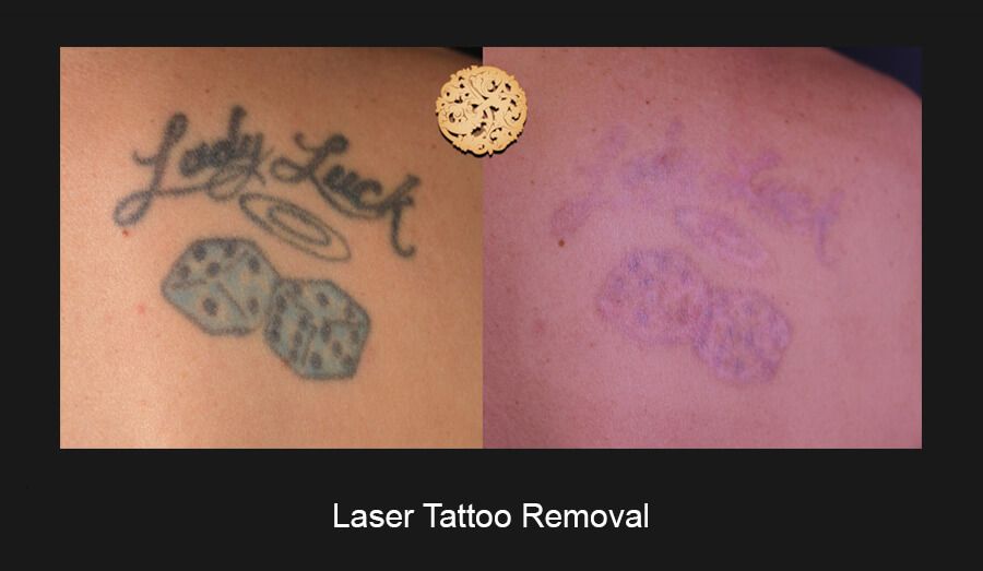 PicoSure Before & After