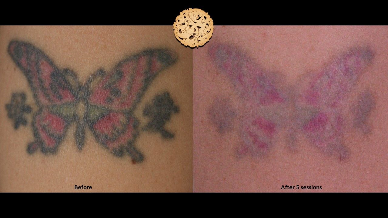 PicoSure Before & After