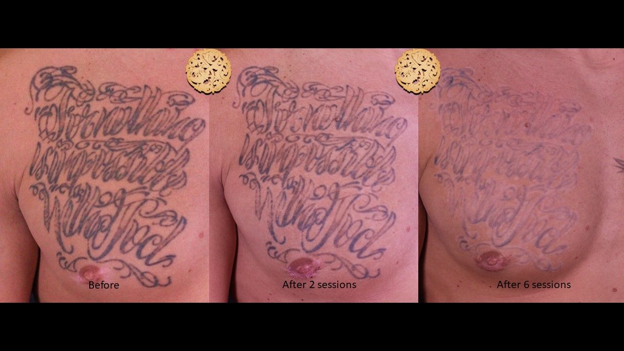 PicoSure Before & After