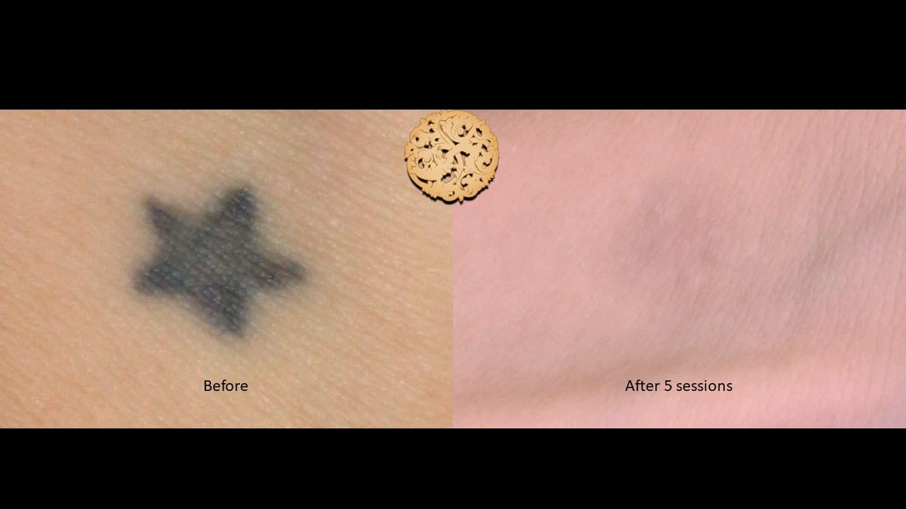 PicoSure Before & After