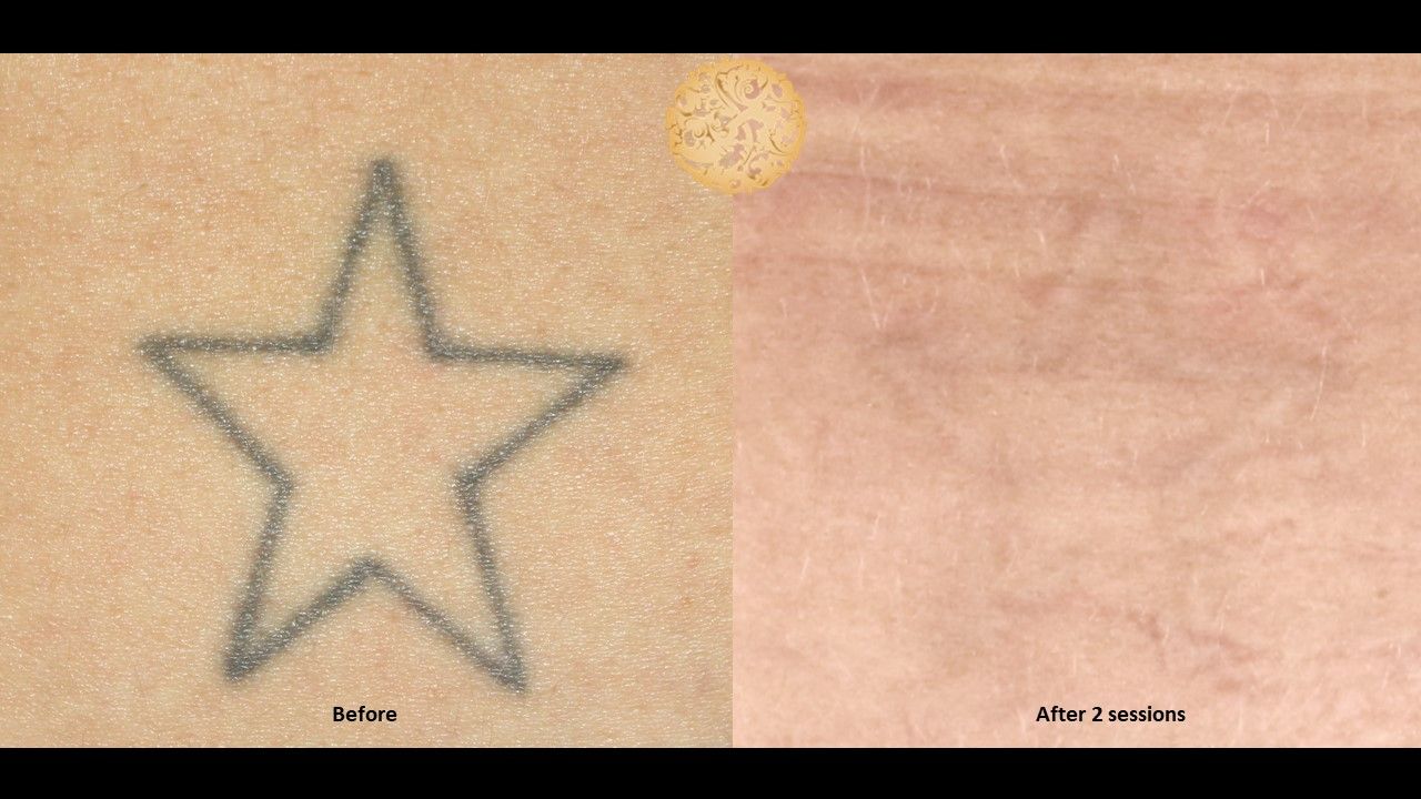 PicoSure Before & After
