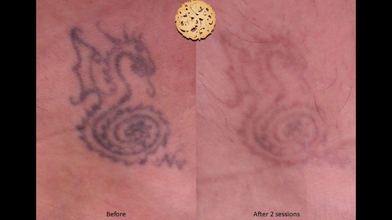 PicoSure Before & After