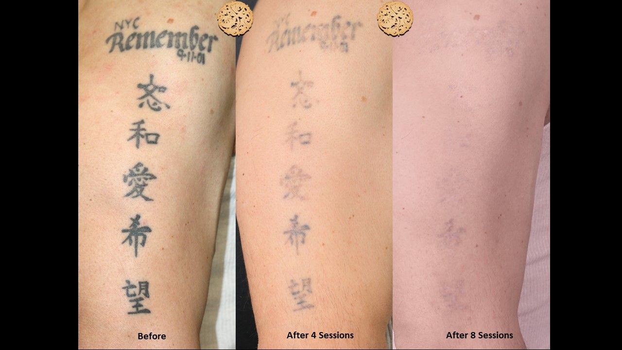 PicoSure Before & After
