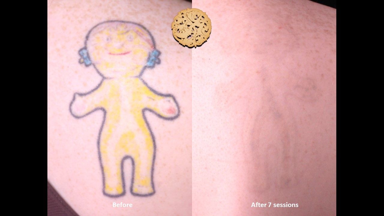 PicoSure Before & After