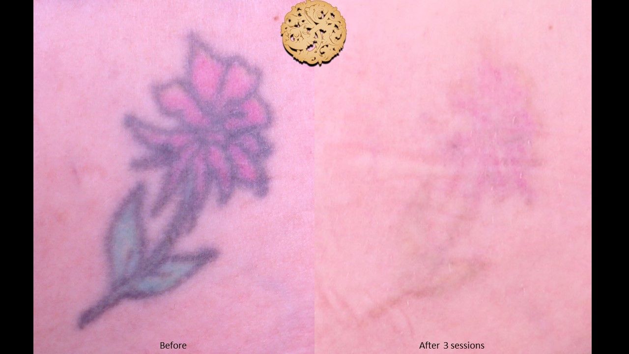 PicoSure Before & After