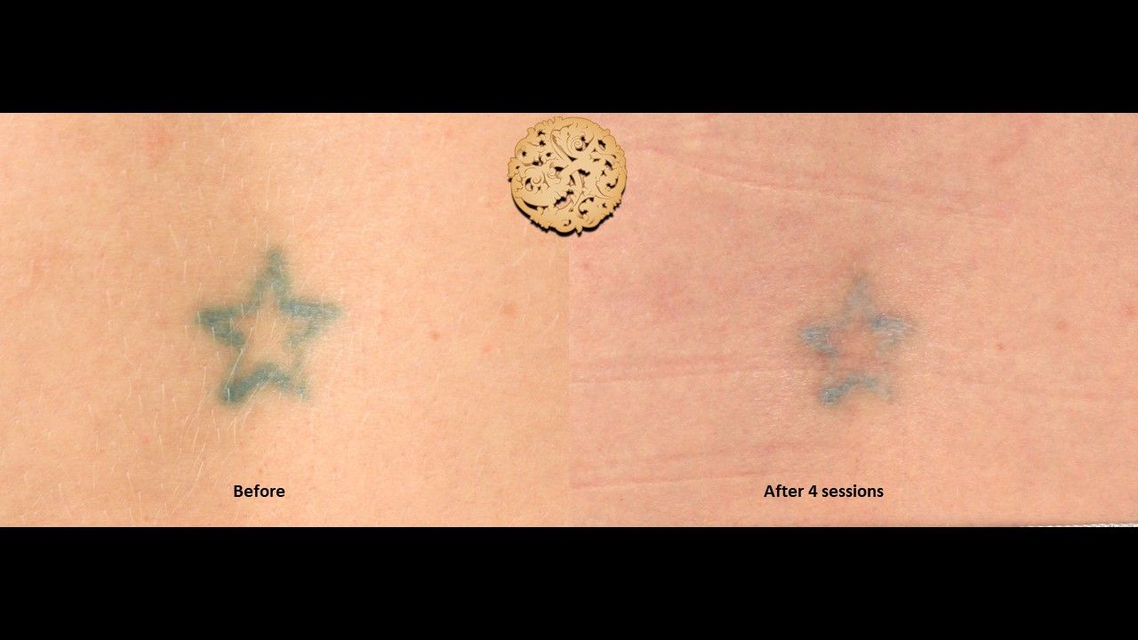 PicoSure Before & After