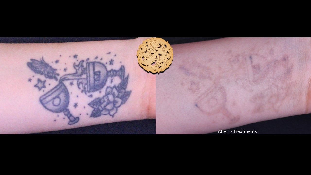 PicoSure Before & After