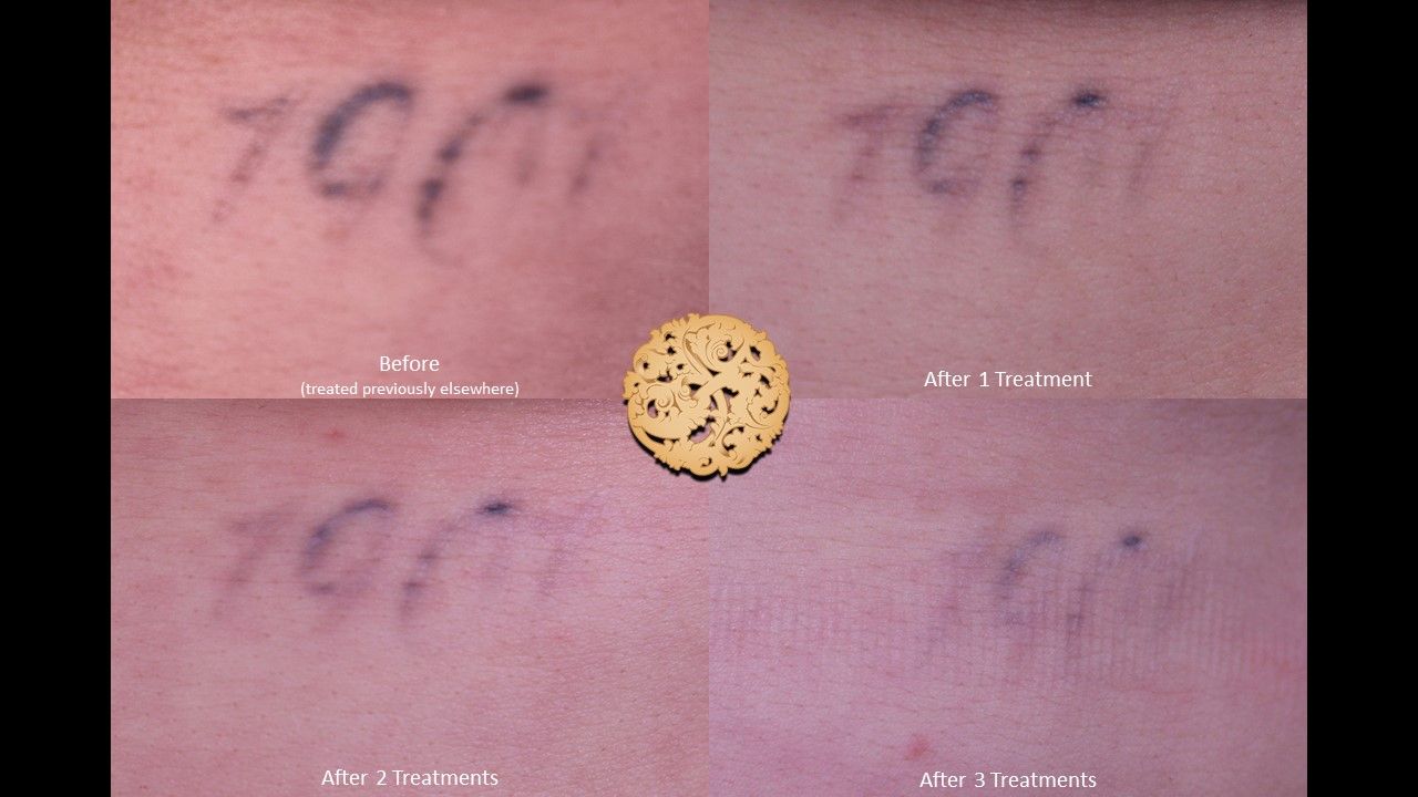 PicoSure Before & After