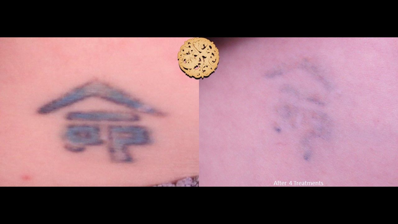 PicoSure Before & After