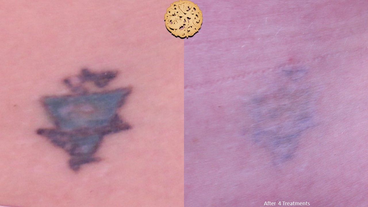 PicoSure Before & After