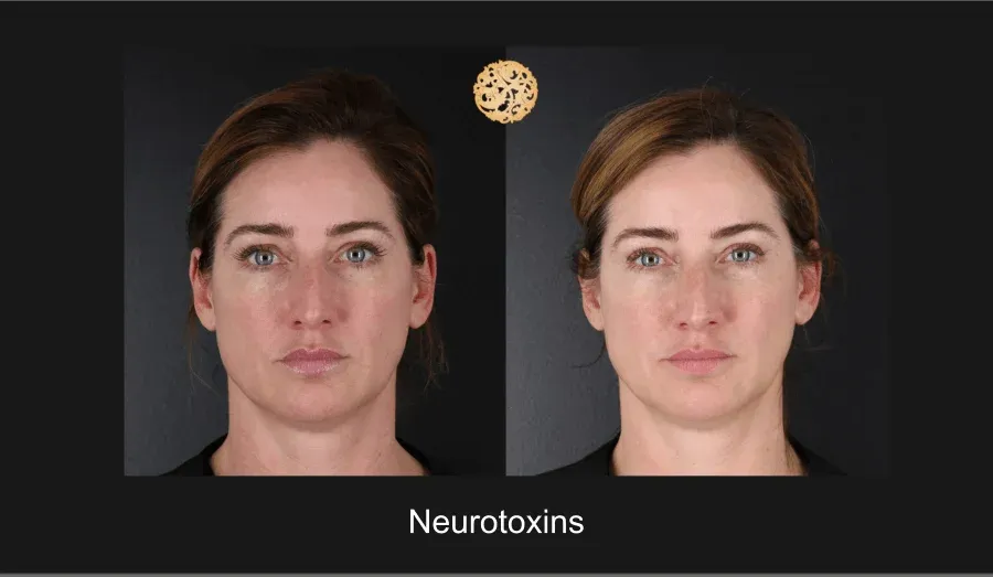 Neurotoxins Before & After