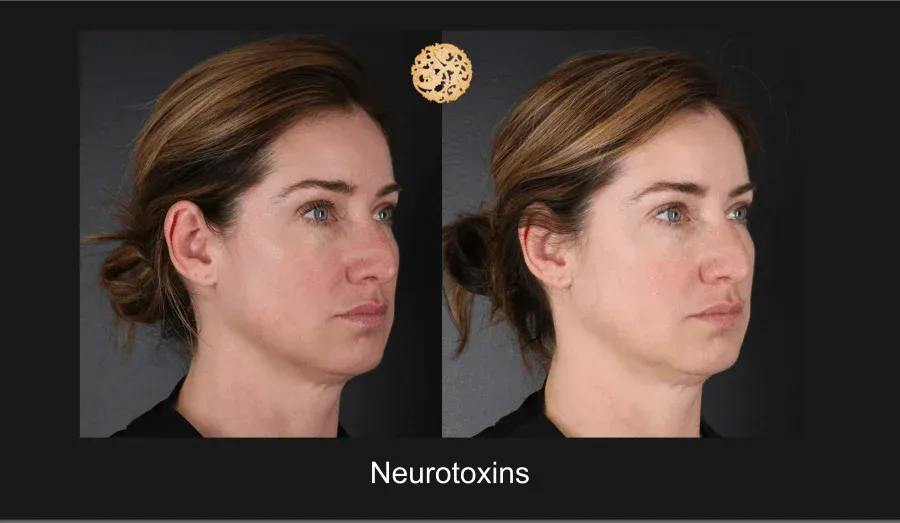 Neurotoxins Before & After