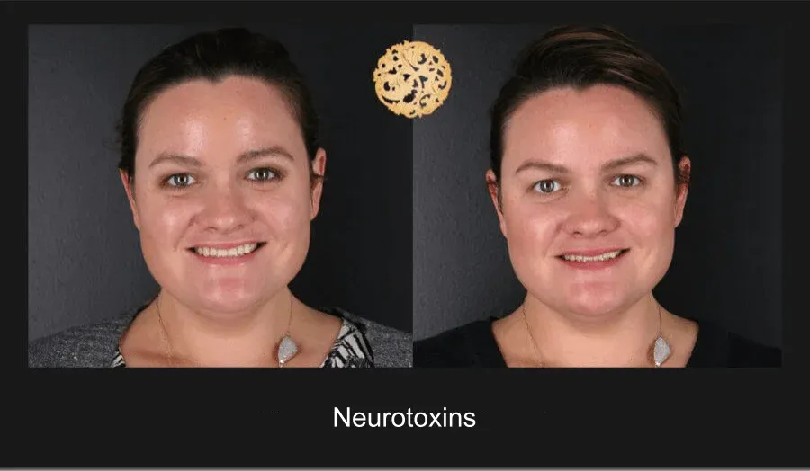 Neurotoxins Before & After