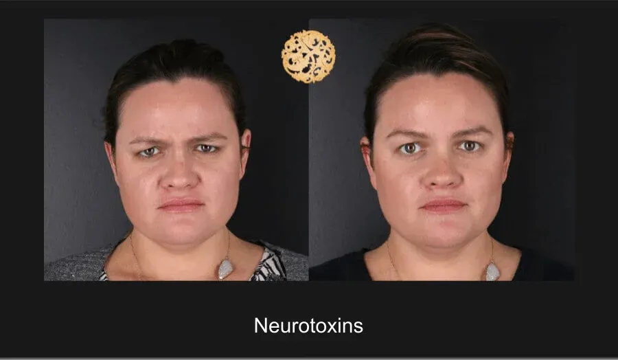 Neurotoxins Before & After
