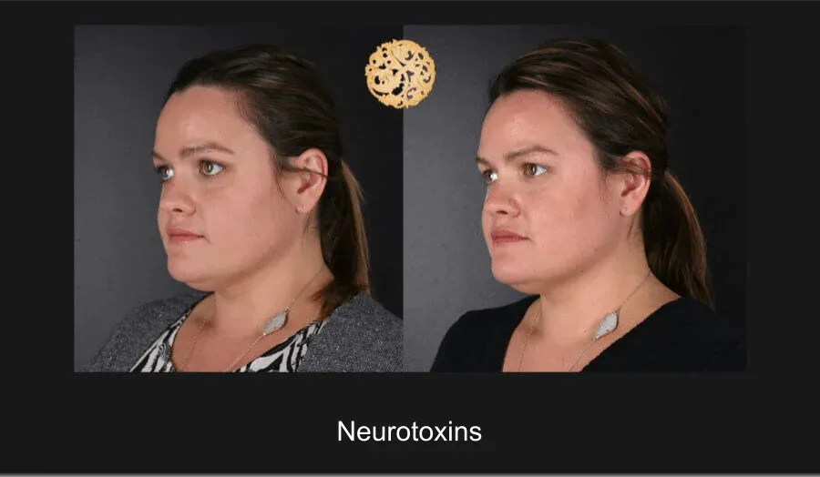 Neurotoxins Before & After
