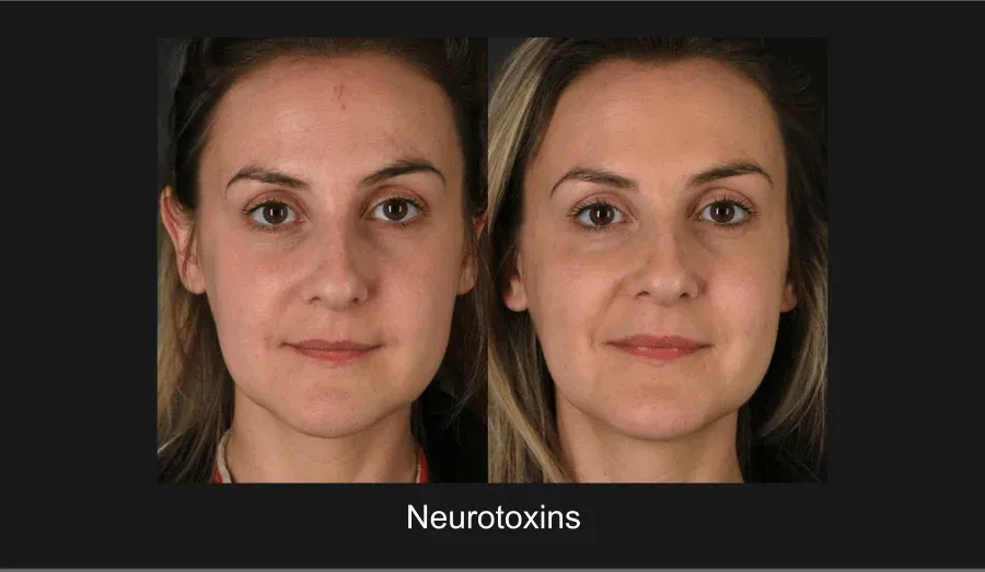 Neurotoxins Before & After