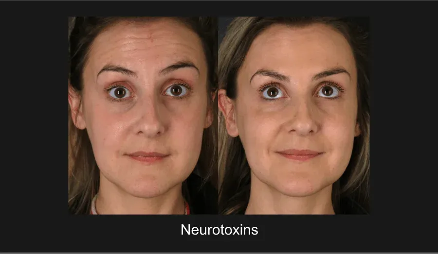 Neurotoxins Before & After