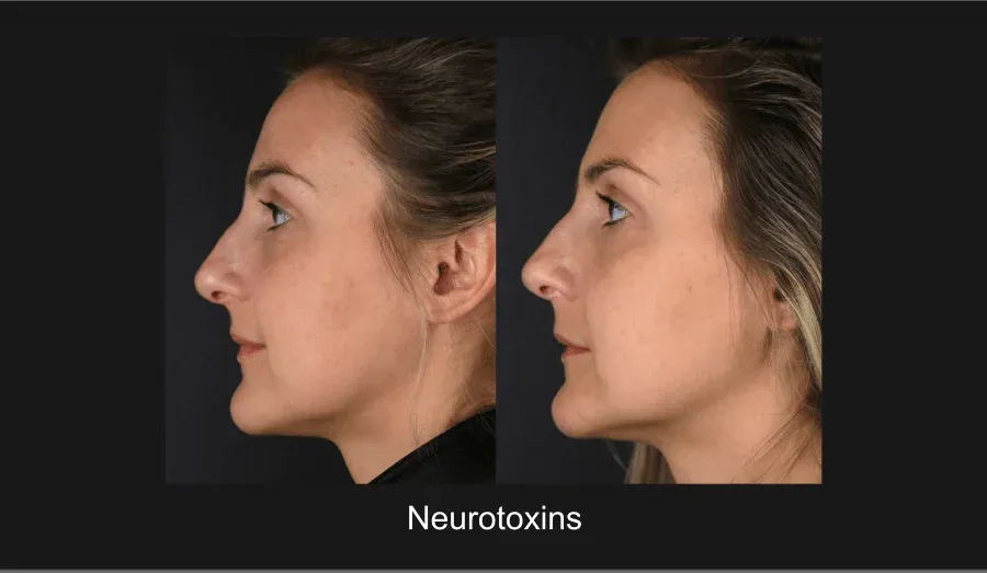 Neurotoxins Before & After