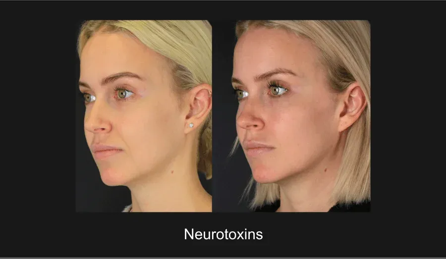 Neurotoxins Before & After