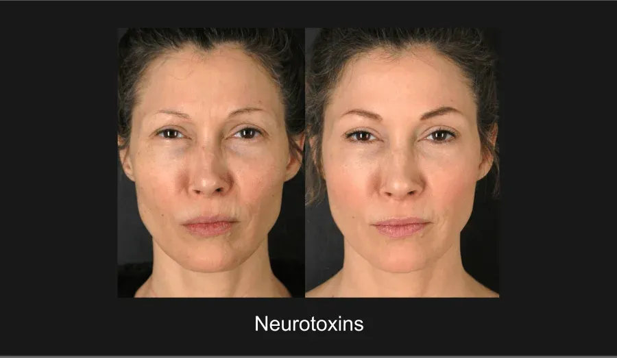 Neurotoxins Before & After