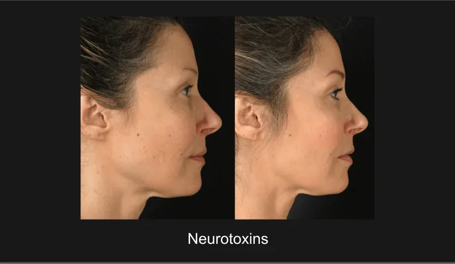 Neurotoxins Before & After