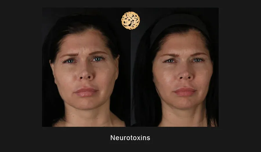 Neurotoxins Before & After