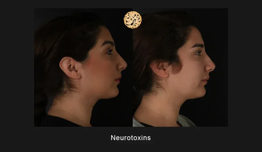 Neurotoxins Before & After