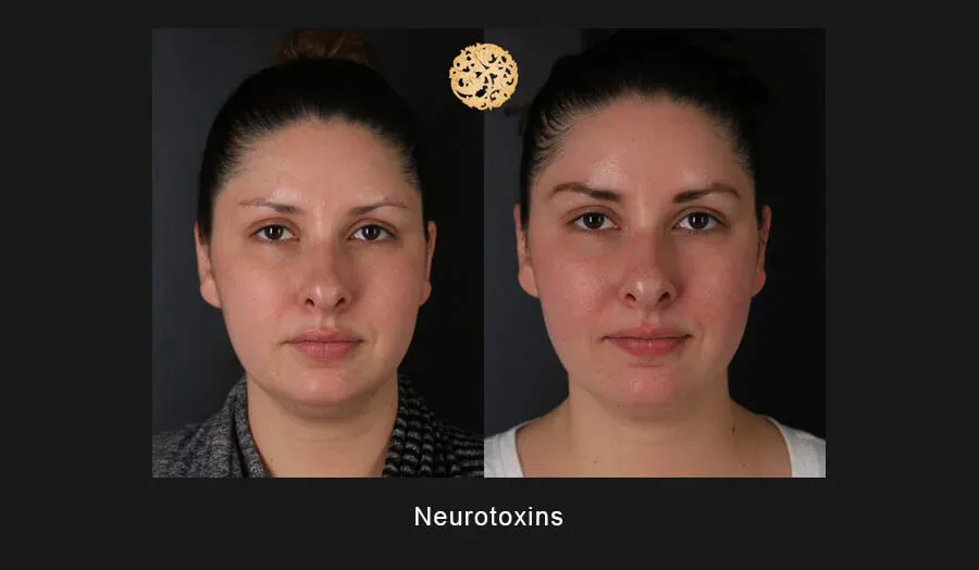 Neurotoxins Before & After